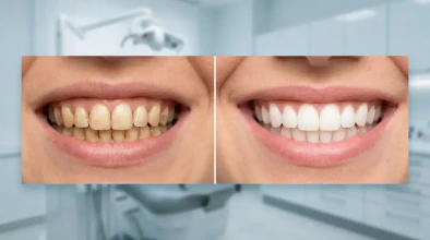 Stain Removal